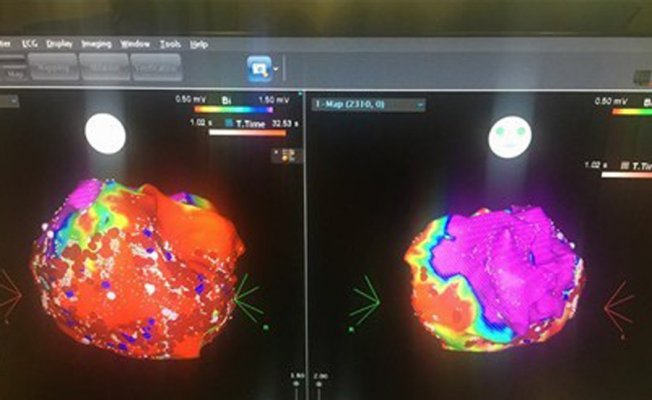 Kalp ritim bozukluklarında yaşam boyu ilaç kullanımına son!